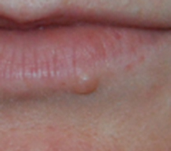 Before Lip Mole Removal with Laser Before Lip Mole Removal with Laser