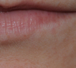 AfterLip Mole Removal with Laser After Lip Mole Removal with Laser