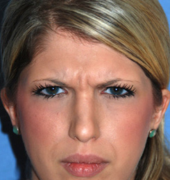 Botox® Dysport® for Glabellar Frown 11 Lines Before Botox® Dysport® for Glabellar Frown 11 Lines Before