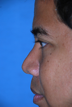 Patrick Chantana Left Lateral View after Patrick Chantana Left Lateral View after
