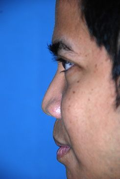 Patrick Chantana Left Lateral View Before Patrick Chantana Left Lateral View Before