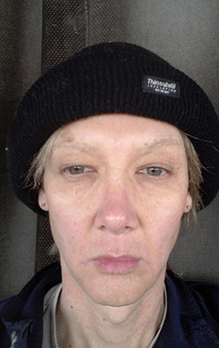 transgender surgery photos transgender surgery photos