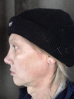 transgender surgery photos transgender surgery photos