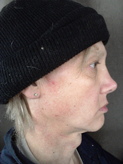 transgender surgery photos transgender surgery photos