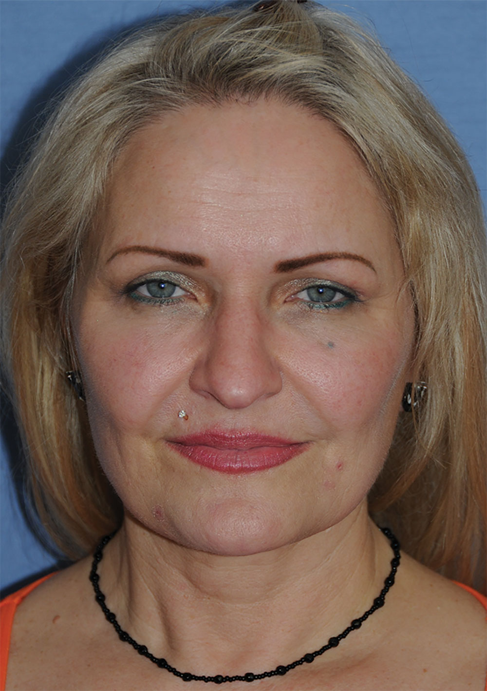 Incision Less Face Lift Eyelift with Traditional Upper Eyelid Blepharoplasty After Image Front View Incision Less Face Lift Eyelift with Traditional Upper Eyelid Blepharoplasty After Image Front View