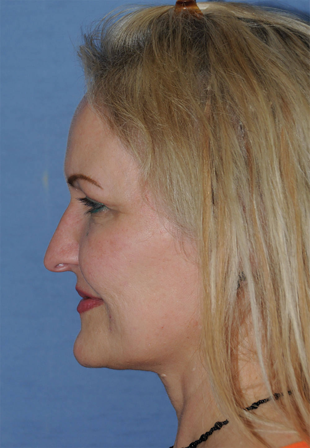 Incision Less Face Lift Eyelift with Traditional Upper Eyelid Blepharoplasty After Image Profile View Incision Less Face Lift Eyelift with Traditional Upper Eyelid Blepharoplasty After Image Profile View