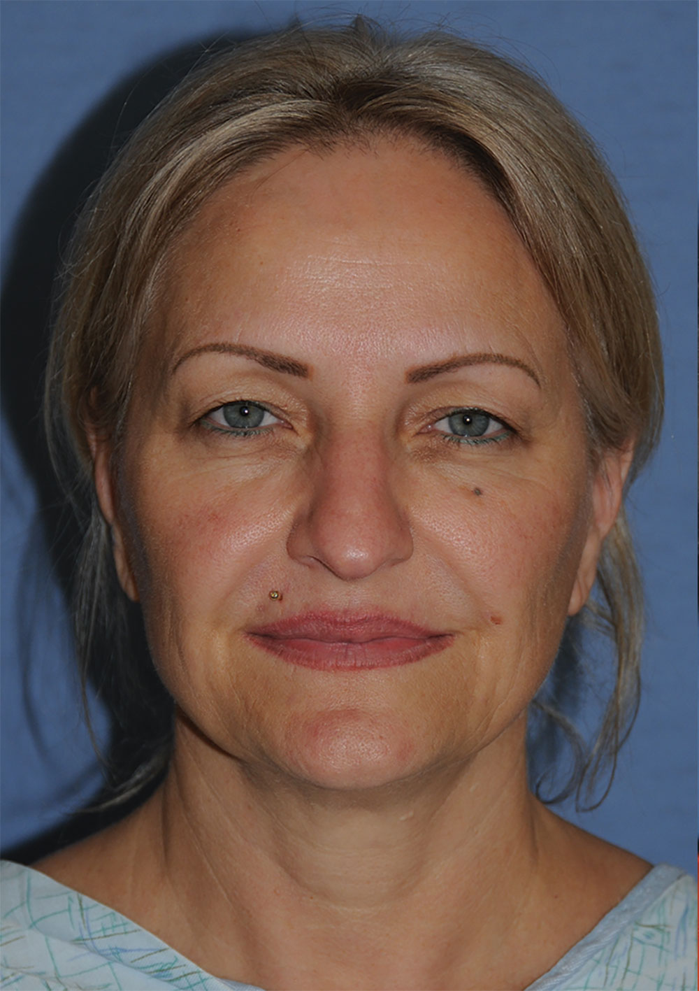 Incision Less Face Lift Eyelift with Traditional Upper Eyelid Blepharoplasty Before Image Front View Incision Less Face Lift Eyelift with Traditional Upper Eyelid Blepharoplasty Before Image Front View