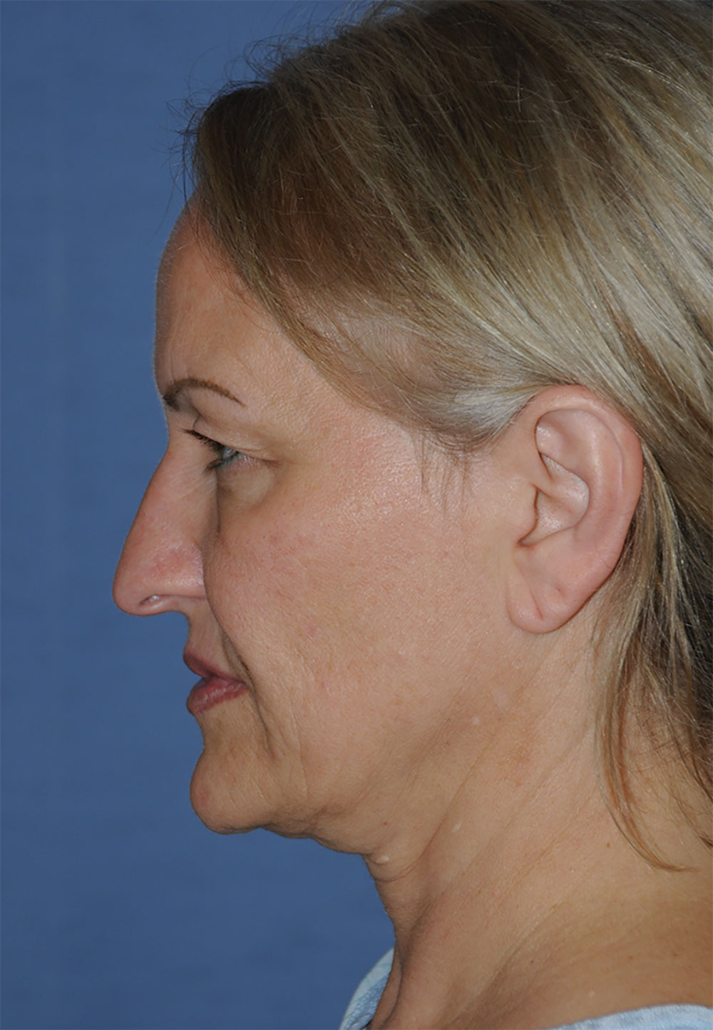 Incision Less Face Lift Eyelift with Traditional Upper Eyelid Blepharoplasty Before Image Profile View Incision Less Face Lift Eyelift with Traditional Upper Eyelid Blepharoplasty Before Image Profile View