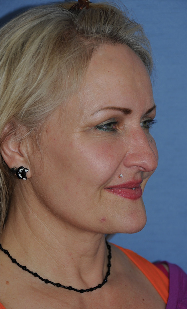 Incision Less Face Lift Eyelift with Traditional Upper Eyelid Blepharoplasty After Image Right Oblique View Incision Less Face Lift Eyelift with Traditional Upper Eyelid Blepharoplasty After Image Right ObliqueView