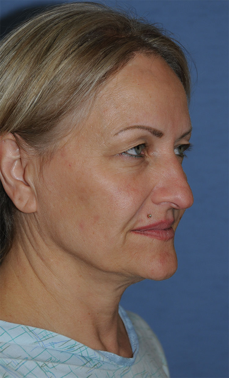 Incision Less Face Lift Eyelift with Traditional Upper Eyelid Blepharoplasty Before Image Right Oblique View Incision Less Face Lift Eyelift with Traditional Upper Eyelid Blepharoplasty Before Image Right Oblique View