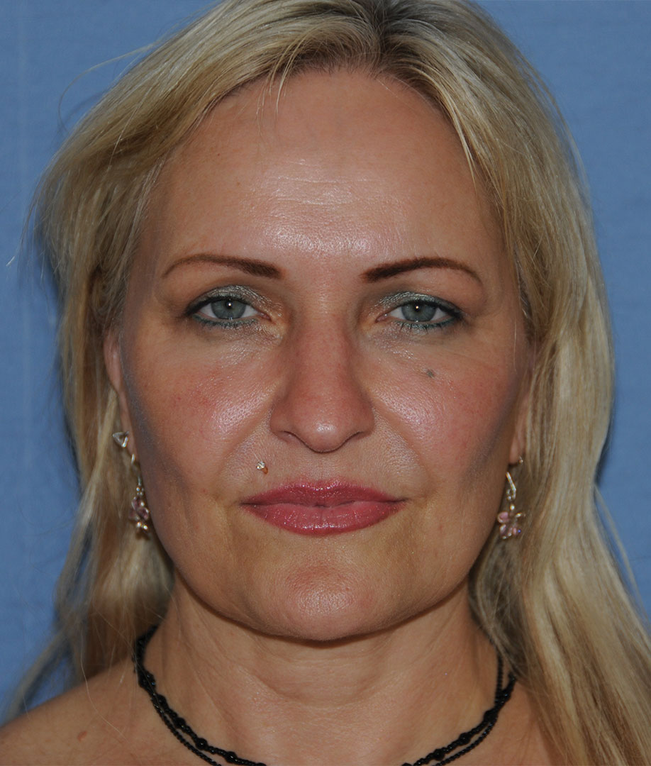 IncisionLess FaceLift & Upper Eyelid lift with Traditional Upper Eyelid Blepharoplasty 8 Month After Image Front View IncisionLess FaceLift & Upper Eyelid lift with Traditional Upper Eyelid Blepharoplasty 8 Month After Image Front View