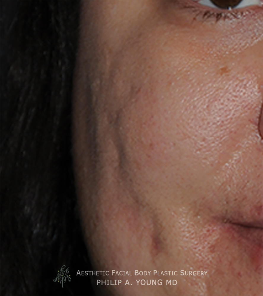 acne scar treatment for Rolling Scars, Box Car Scars Before