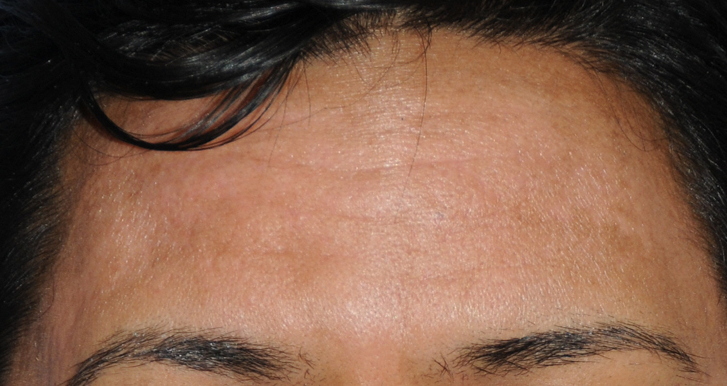Dark Skin Toned Male Patient Acne Scar Vitalizer Treatment After Image for Severe Scarring in the Forehead