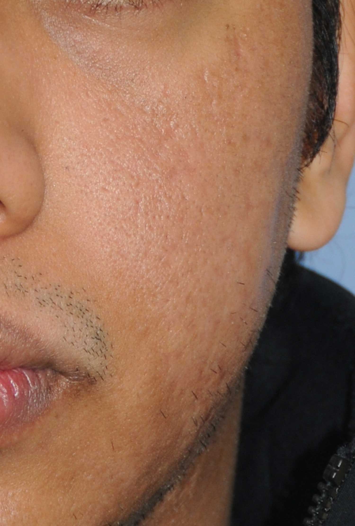 Dark Skin Toned Male Patient Acne Scar Vitalizer Treatment After Image for Severe Scarring in the Left Cheek