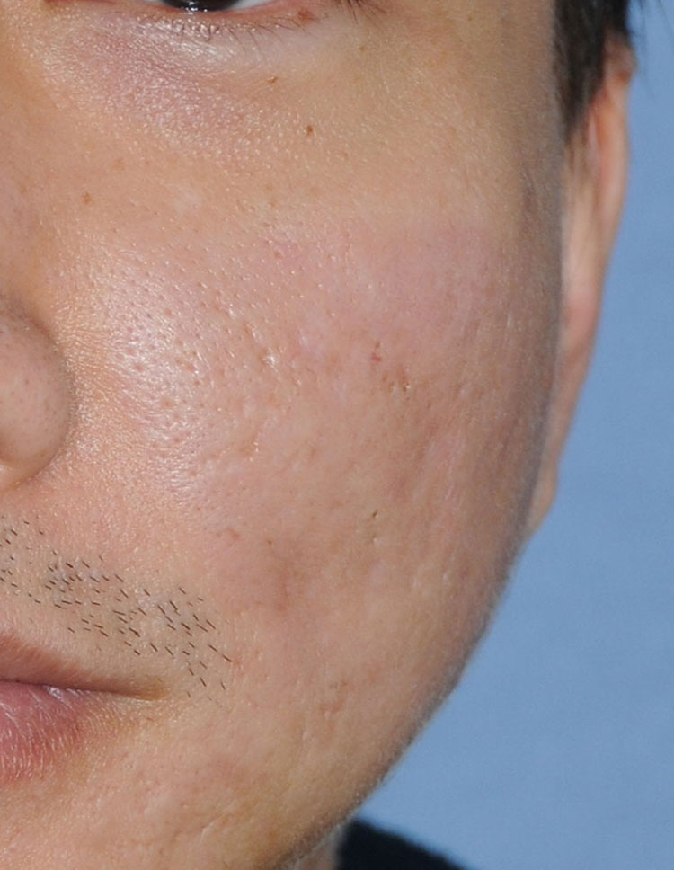 Acne Scar Vitalizer Treatment After Close Up Image of the Left Cheek for this 40's Asian Male