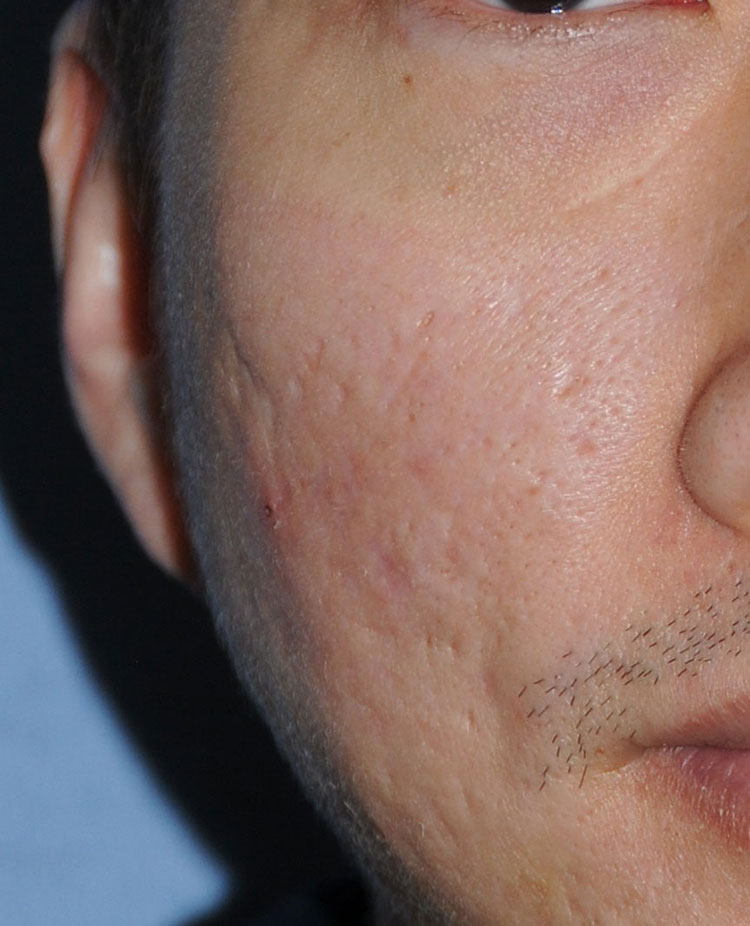 Acne Scar Vitalizer Treatment After Close Up Image of the Right Cheek for this 40's Asian Male