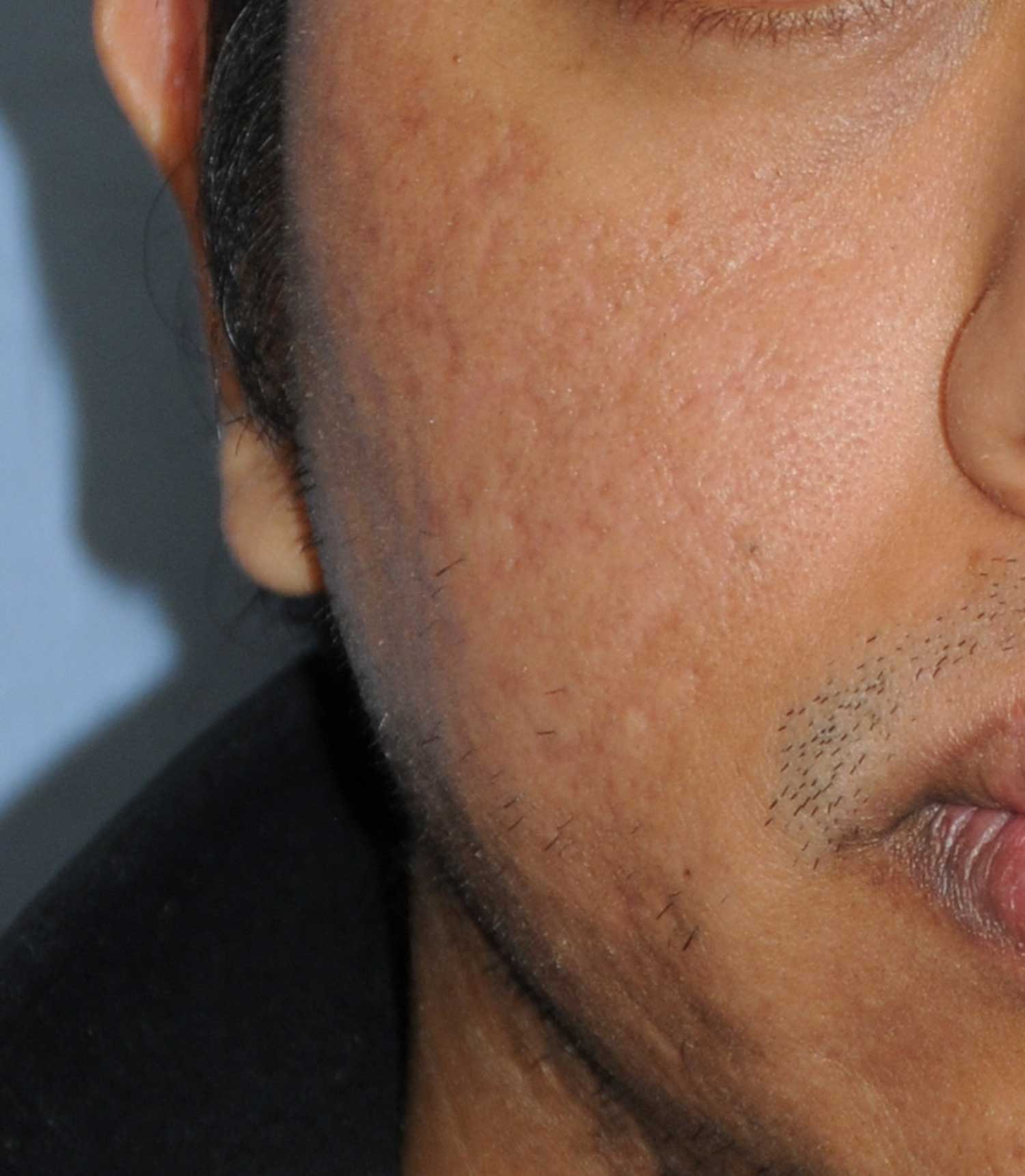 Dark Skin Toned Male Patient Acne Scar Vitalizer Treatment After Image for Severe Scarring in the Cheeks
