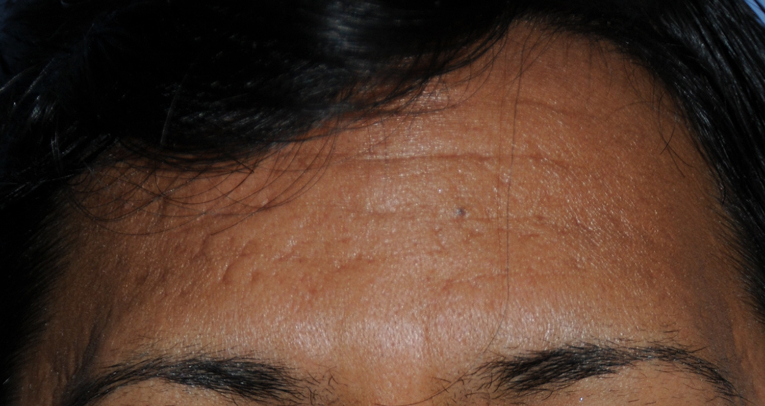 Dark Skin Toned Male Patient Acne Scar Vitalizer Treatment Before Image for Severe Scarring in the Forehead