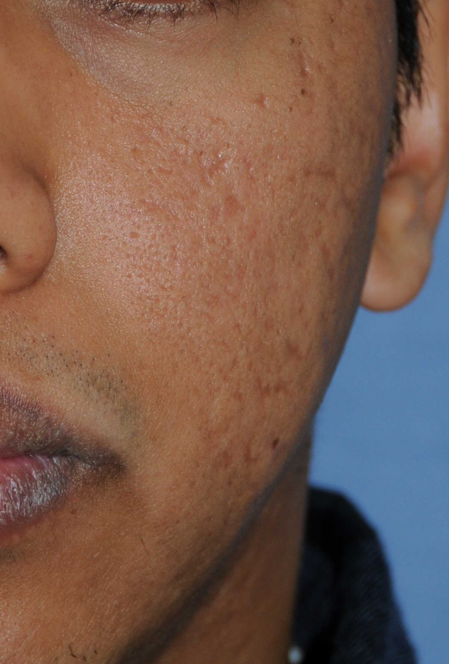 Dark Skin Toned Male Patient Acne Scar Vitalizer Treatment Before Image for Severe Scarring in the Left Cheek