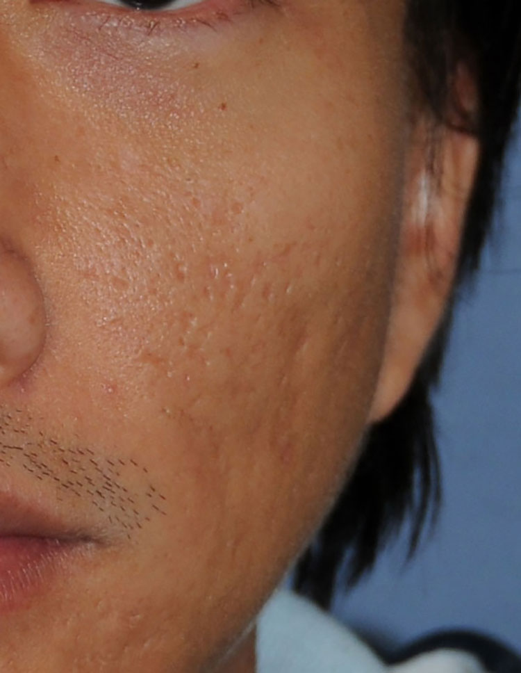 Acne Scar Vitalizer Treatment Before Close Up Image of the Left Cheek for this 40's Asian Male