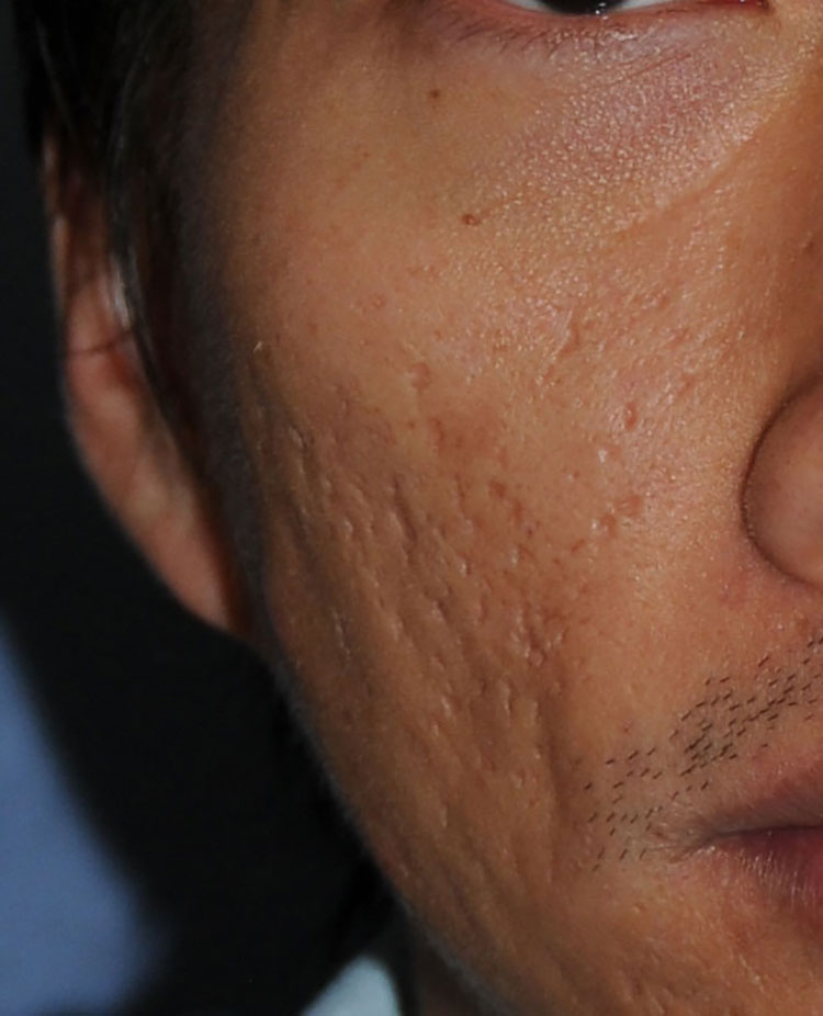 Acne Scar Vitalizer Treatment Before Close Up Image of the Right Cheek for this 40's Asian Male