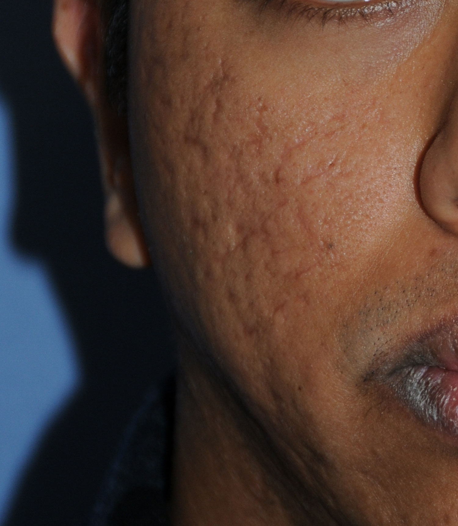 Dark Skin Toned Male Patient Acne Scar Vitalizer Treatment Before Image for Severe Scarring in the Cheeks