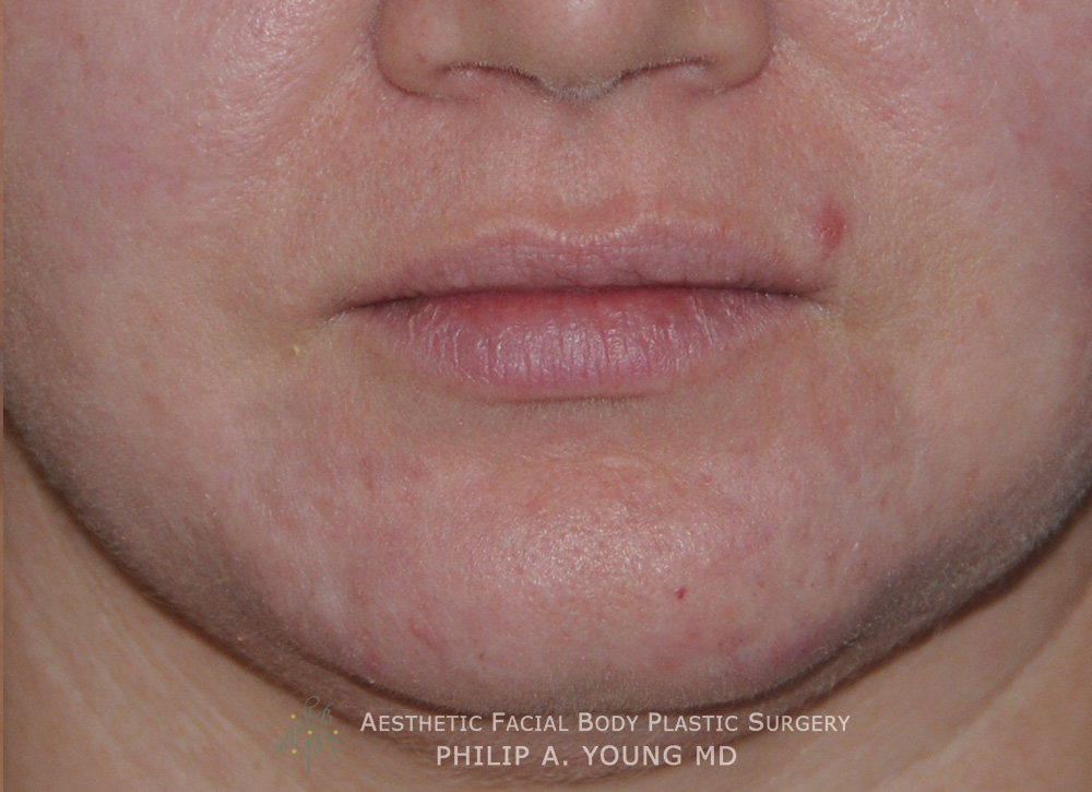 Caucasian Acne Scar Vitalizer Treatment Before Afters of the Chin and Mouth Area After