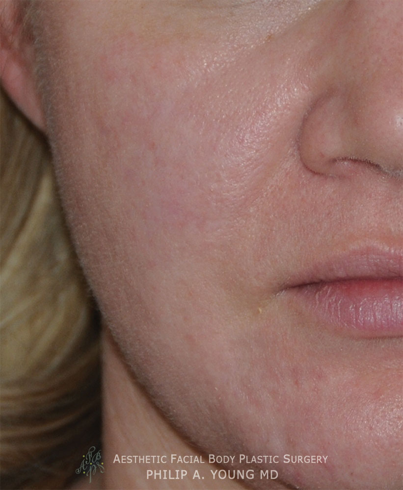 Caucasian Acne Scar Vitalizer Treatment Before Afters of the Right Cheek After