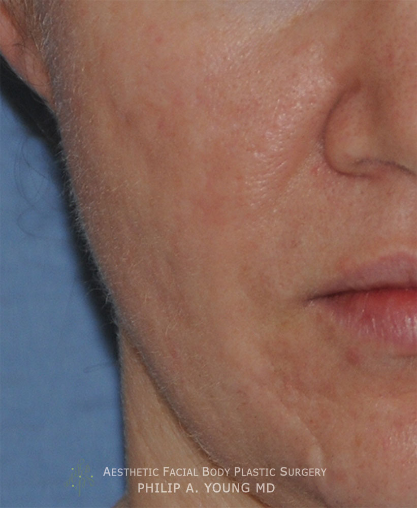Caucasian Acne Scar Vitalizer Treatment Before Afters of the Right Cheek Before