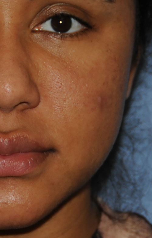 Acne Scar Vitalizer African American 6 months After Treatment Left Front Close Up