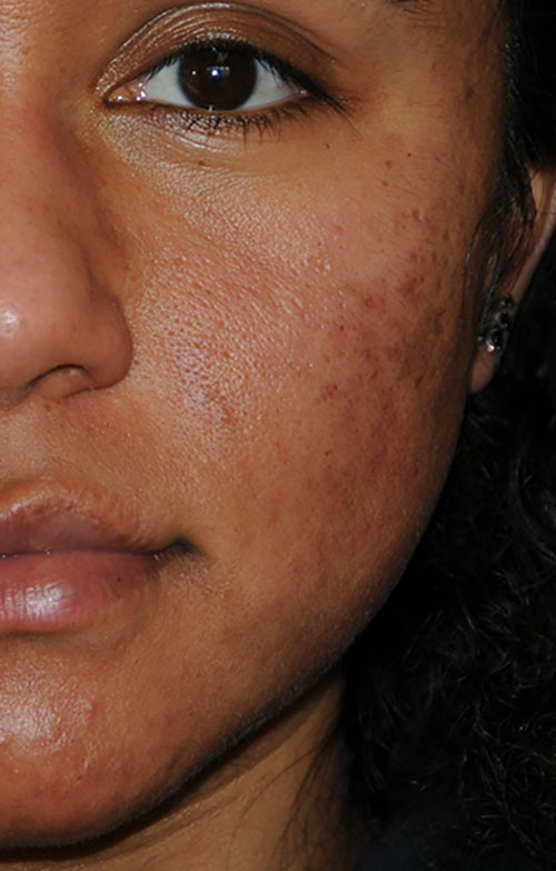 Acne Scar Vitalizer African American Before Treatment Left Front Close Up