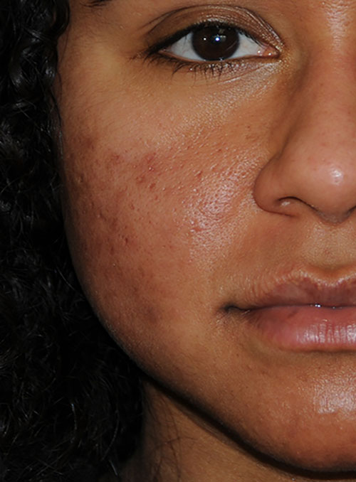 Acne Scar Vitalizer African American Before Treatment Right Front Close Up