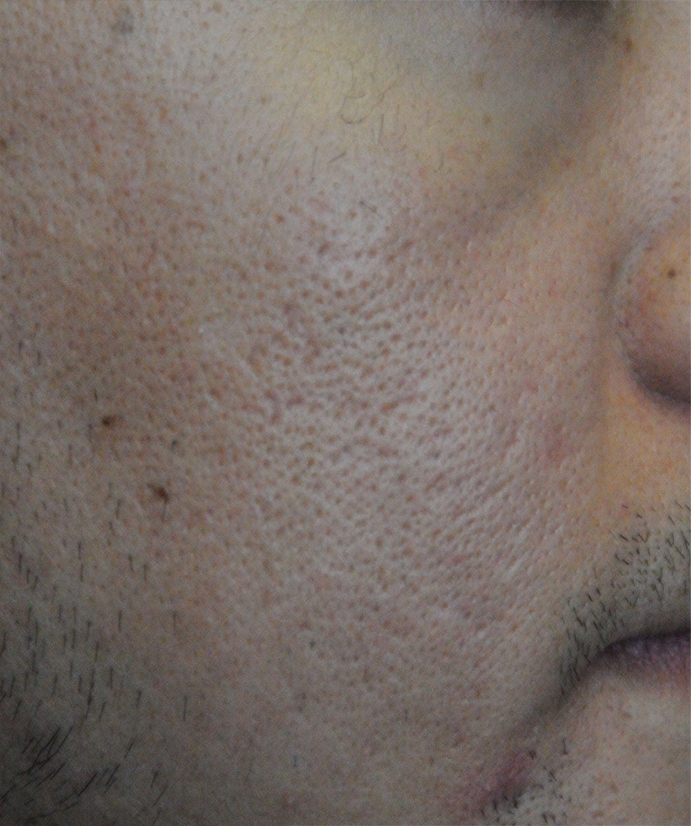 After Acne Scar Vitalizer Laser Treatment for Ice Pick, Box Car Scars of the Right Cheek 20's Asian Male 4 months after Procedure Extreme Close Up View