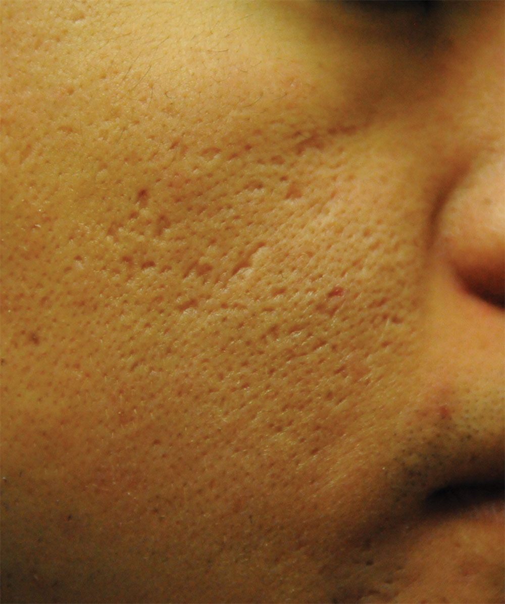 Before Acne Scar Vitalizer Laser Treatment for Ice Pick, Box Car Scars of the Right Cheek 20's Asian Male 4 months after Procedure Extreme Close Up View