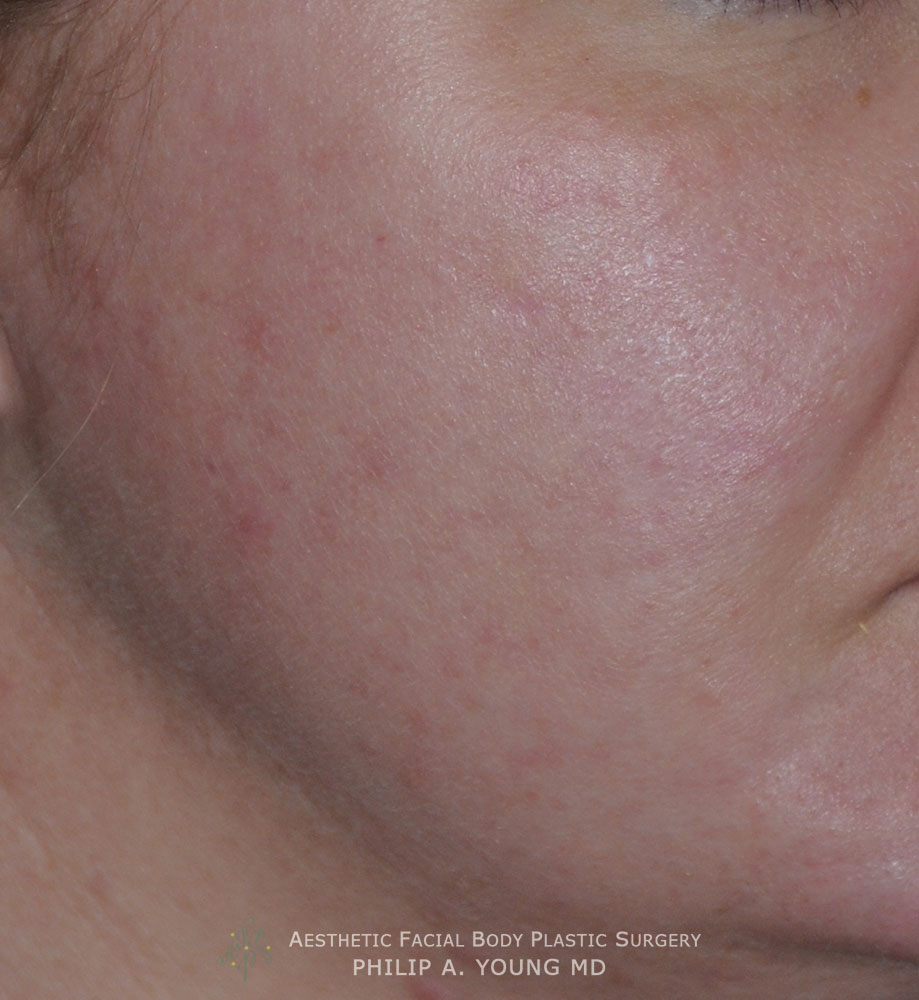 Caucasian Acne Scar Vitalizer Treatment Before Afters of the Right Cheek Chin Oblique After