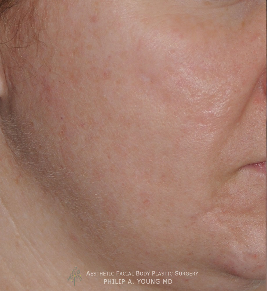 Caucasian Acne Scar Vitalizer Treatment Before Afters of the Right Cheek Chin Before