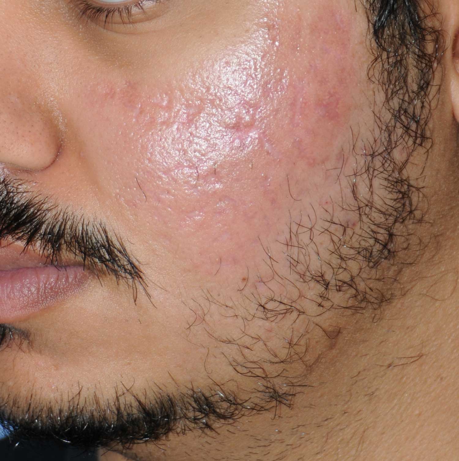 Moderately Dark Skin Toned Patient Acne Scar Vitalizer Treatment After Images of the Left Cheeks and Temples