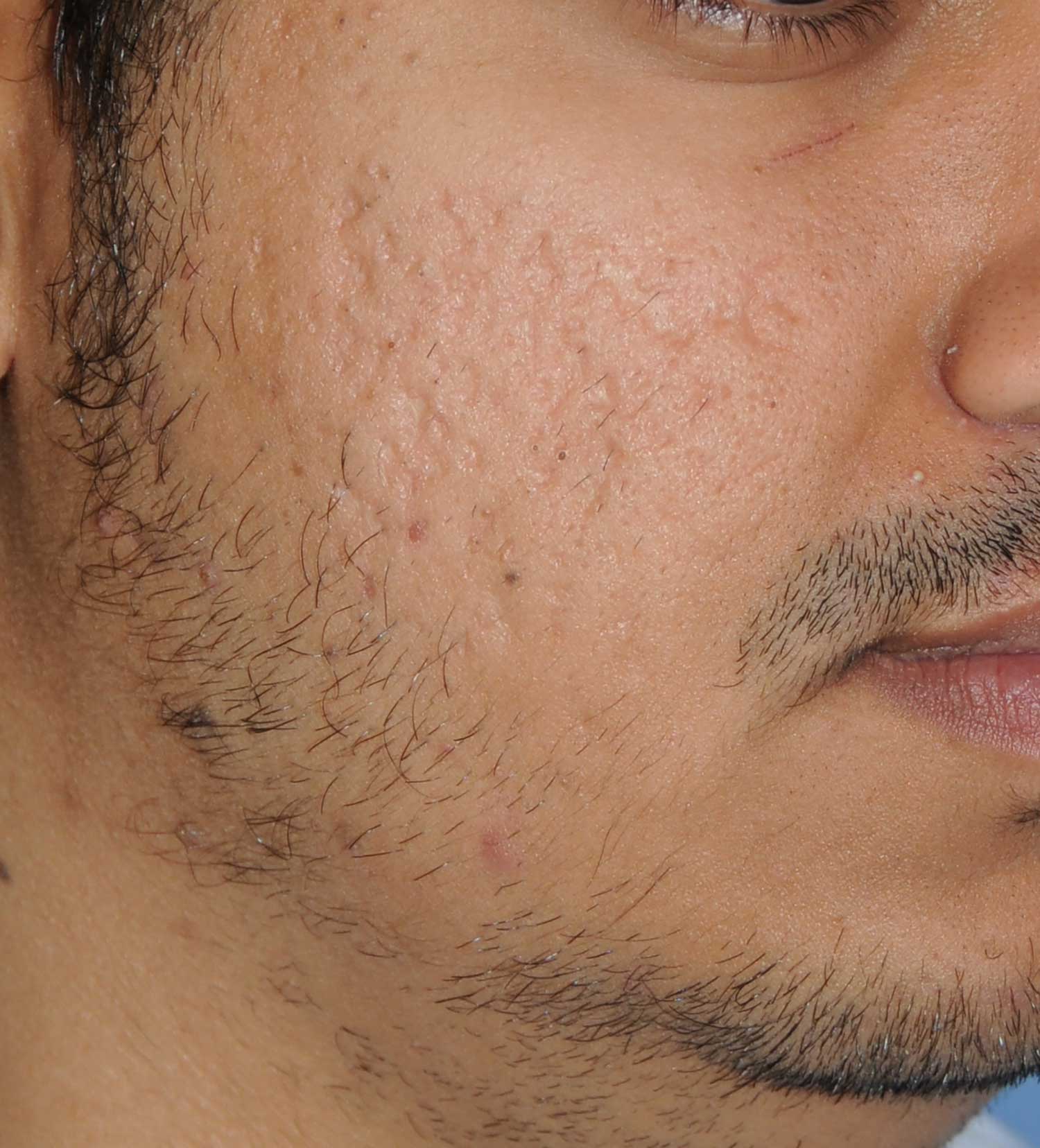 Moderately Dark Skin Toned Patient Acne Scar Vitalizer Treatment Before Images of the Right Cheeks and Temples