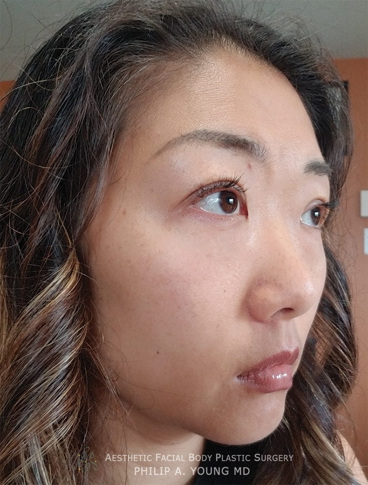 Blepharoplasty Bellevue - Eyelid Lift Bellevue - Seattle