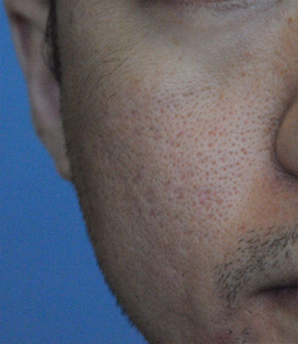 After Acne Scar Vitalizer Laser Treatment for Ice Pick, Box Car Scars of the Right Cheek 20's Asian Male 4 months after Procedure
