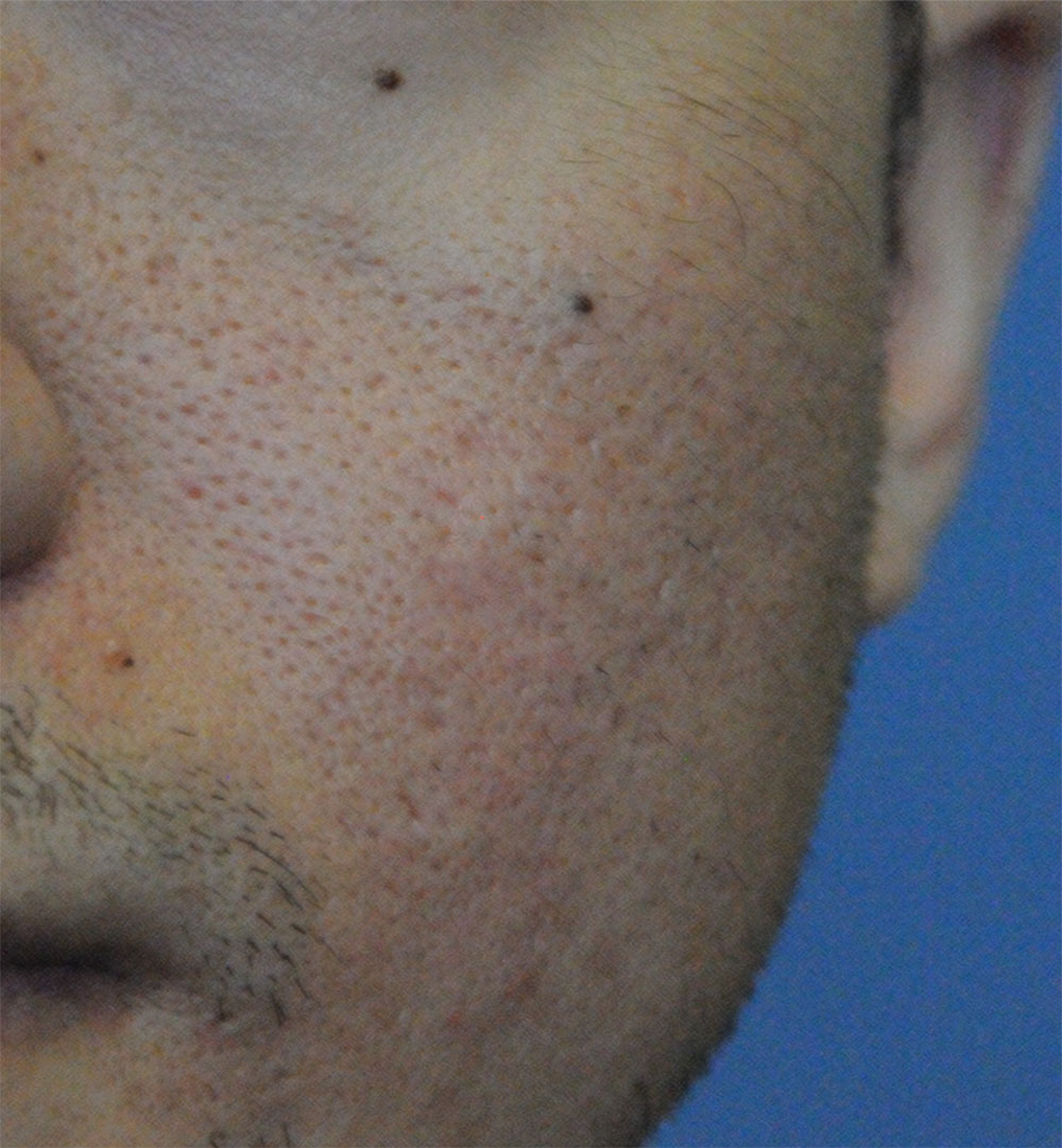 After Acne Scar Vitalizer Laser Treatment for Ice Pick, Box Car Scars of the Left Cheek 20's Asian Male 4 months after Procedure