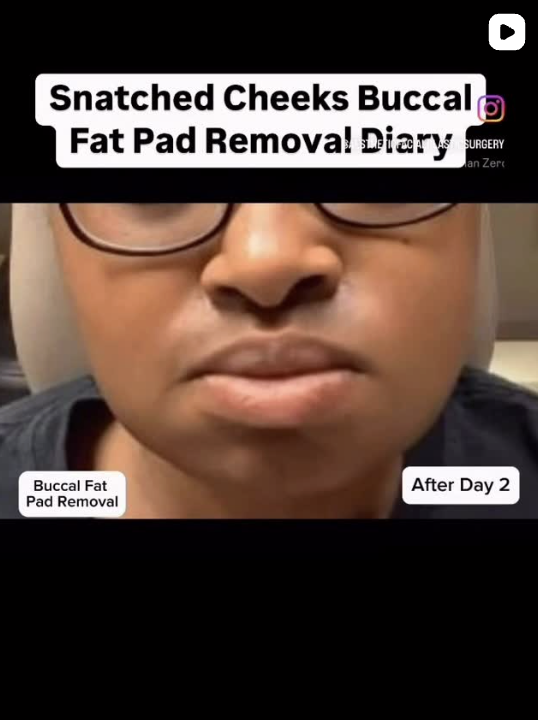 Watch Dr. Young Buccal Fat Removal Healing Diary