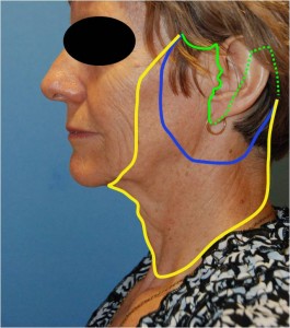 Facelift figure 8 Different Variations of the Face Lift | S Lift | Mini Face Lift | Deep Plane LiftDr Young Bellevue Washington