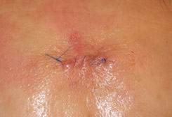 Recovery mole excision Skin excision