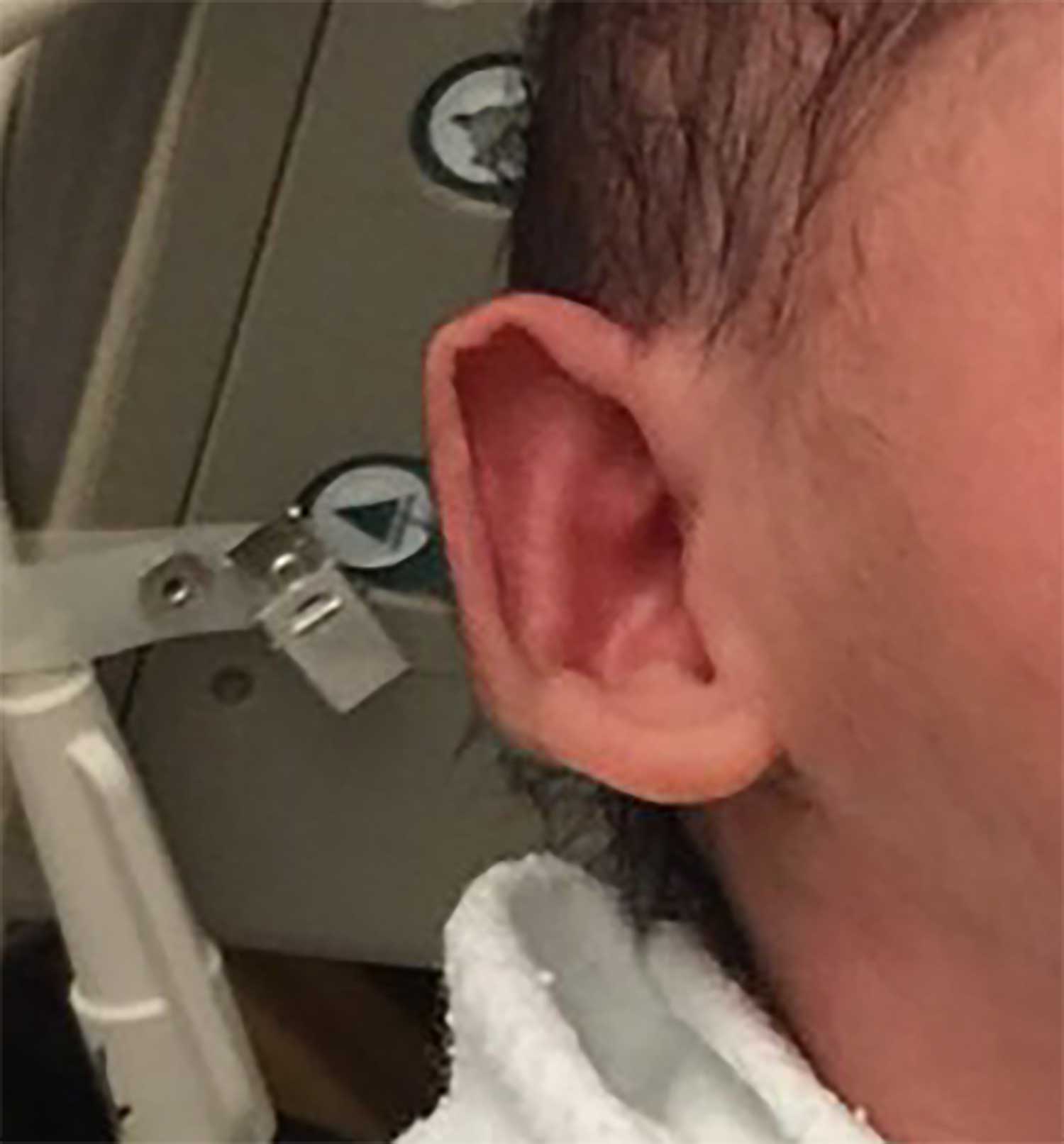 Ear plastic surgery (otoplasty) before photos from Dr Philip Young