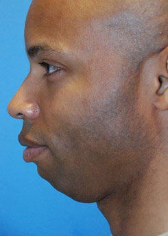 Chin implant Before & After photos at Aesthetic Facial Body in Seattle & Bellevue