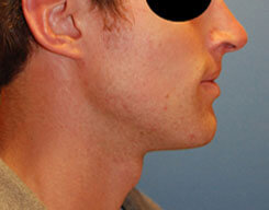 Jaw silicone implants After photos from Dr Philip Young in Seattle & Bellevue