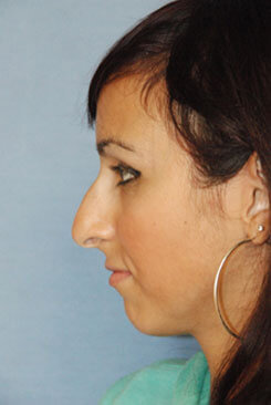 Non surgical rhinoplasty before photos from Dr Philip Young