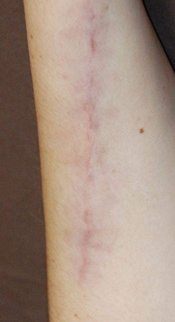 Scar Treatment For Self Induced Scars On The Arms Seattle Bellevue