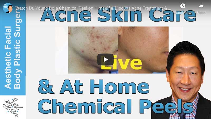 Watch Dr. Young Do a Chemical Peel on Himself & Discuss Acne Treatment & At Home Glycolic Peels
